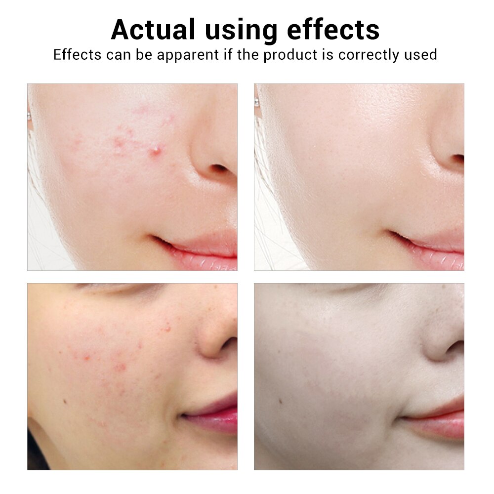 BREYLEE Acne Treatment Face Serum Mask - Anti Acne Pimple Scar Remover - Premium Face Serum Mask from Concordia Style Boutique - Just $14.82! Shop now at Concordia Style Boutique