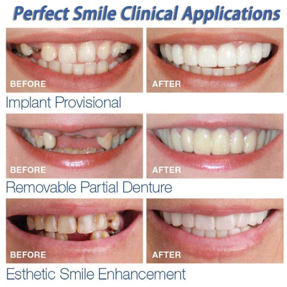 Instant Perfect Smile Dental Veneers - Concordia Style Boutique