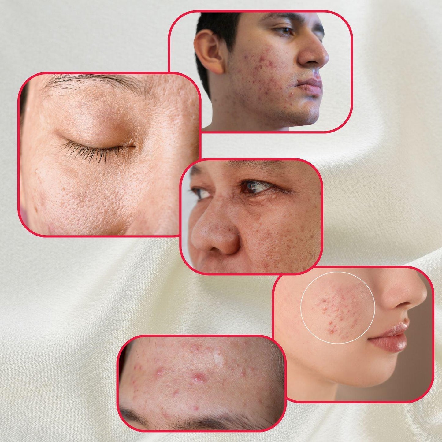Perfect Trifecta Acne Peel - Concordia Style Boutique