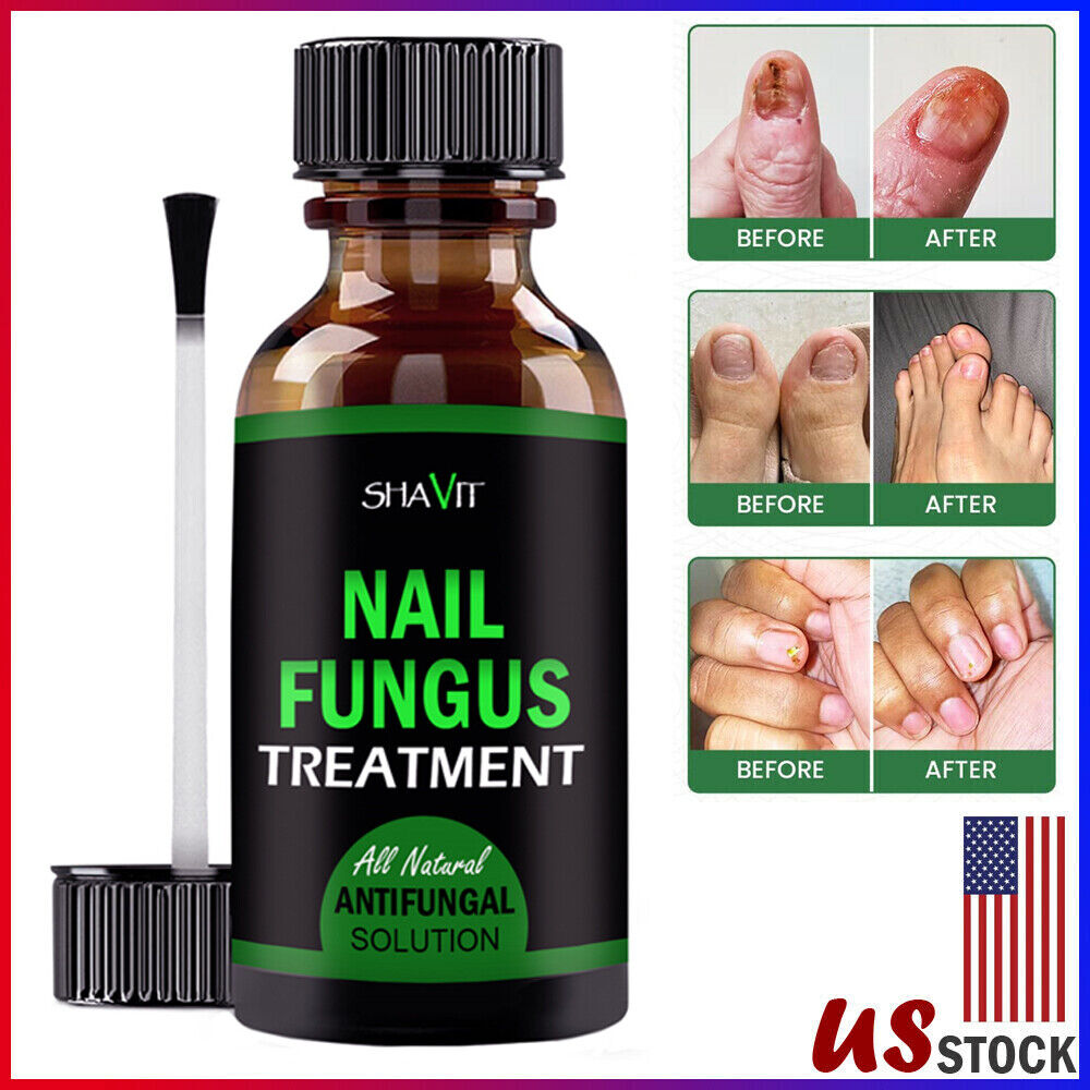 Toenail And Fingernail Fungus Treatment Extra Strength Antifungal Athletes Foot - Premium Nail Care from erDouckan - Just $20! Shop now at Concordia Style Boutique