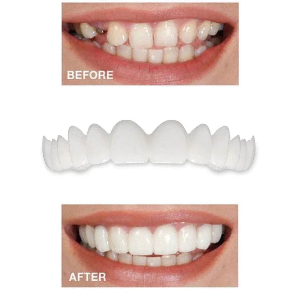 Instant Perfect Smile Dental Veneers - Concordia Style Boutique