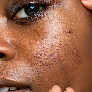 Mighty Patch™ Invisible+ patch from Hero Cosmetics - Daytime Hydrocolloid Acne Pimple Patches for Covering Zits and Blemishes, Ultra Thin Spot Stickers for Face and Skin, Vegan-friendly (39 Count) - Premium Hydrocolloid Acne Pimple Patches from Concordia Style Boutique - Just $20.86! Shop now at Concordia Style Boutique