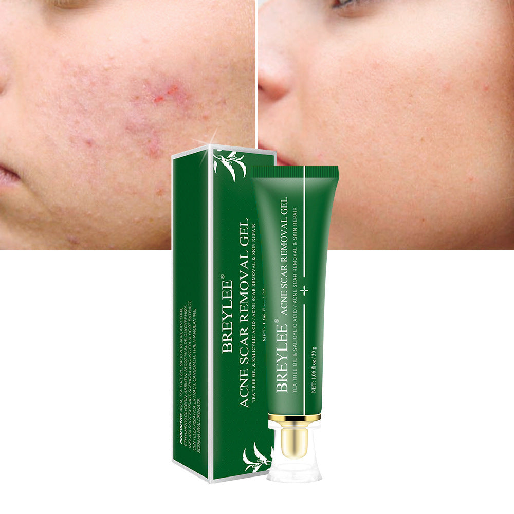 Acne Scar Removal Gel - Premium Acne Scar Removal Gel from Concordia Style Boutique - Just $7.87! Shop now at Concordia Style Boutique