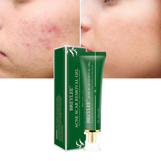 Acne Scar Removal Gel - Premium Acne Scar Removal Gel from Concordia Style Boutique - Just $7.87! Shop now at Concordia Style Boutique