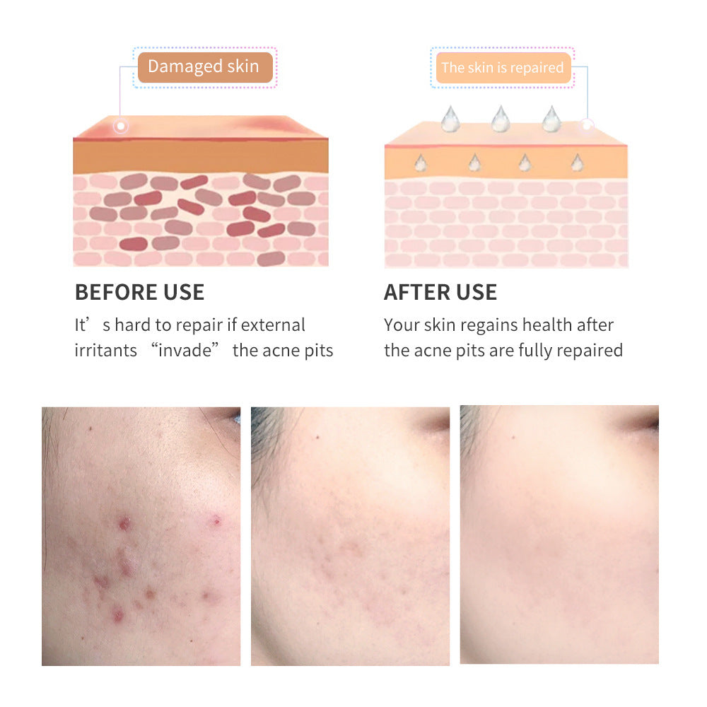 Acne Scar Removal Gel - Premium Acne Scar Removal Gel from Concordia Style Boutique - Just $7.87! Shop now at Concordia Style Boutique