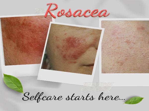 Organic Moisturizer for Rosacea Prone Skin - For Women & Men - Concordia Style Boutique