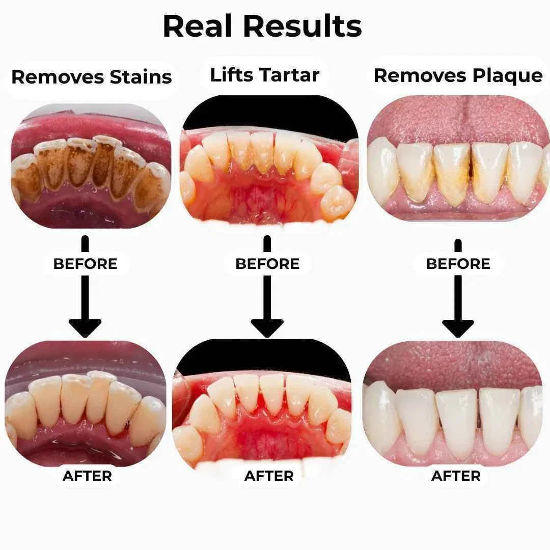 T4 Ultrasonic Tooth Cleaner | Safe & Effective Dental Care